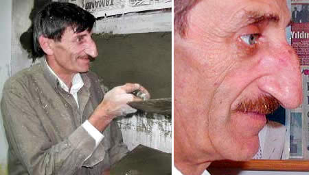 Mehmet Ozyurek: World's Longest Nose --4.5 inches