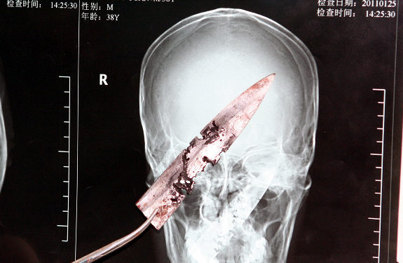 Chinese dude has 4 inch blade lodged in his head from a bar fight from 4 years prior!