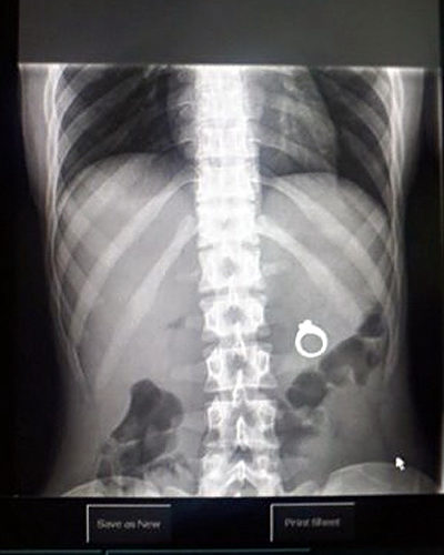 Dude thinks it would be cute to propose by slipping ring into GF's shake. GF tosses the straw and swallows all. She said yes upon viewing xray!