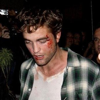 Robert Pattison beat up, Can't say I'm not Glad
