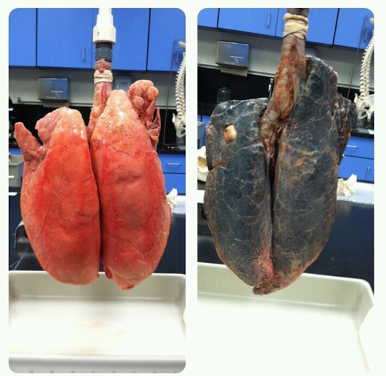 Comparison of healthy lungs and smoker's lungs.