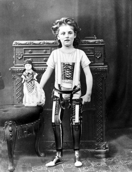 Prosthetic legs in 1900.