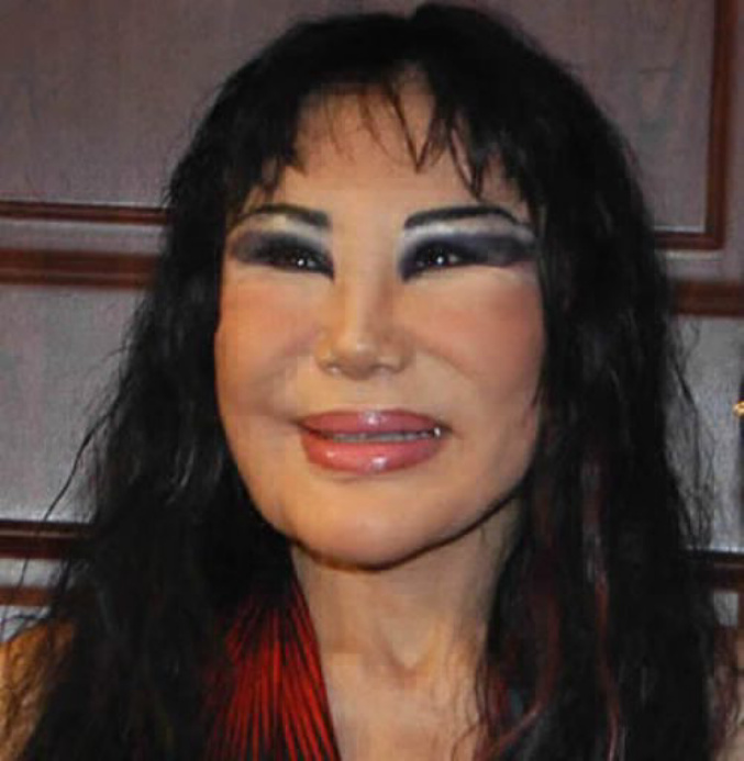21 Shocking Cases Of Plastic Surgery Disasters