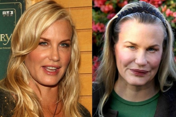 21 Shocking Cases Of Plastic Surgery Disasters