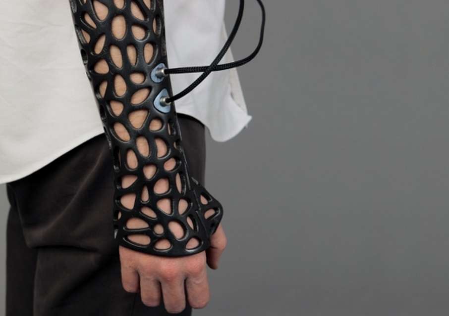 3D cast with ultrasound technology to help heal the bones faster