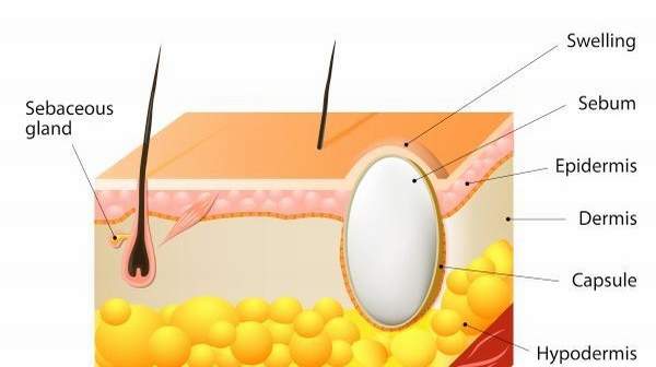 A trichilemmal cyst forms from a hair follicle and consists mainly of keratine (which normally makes hair) in a 'wet' form. This then grows and doesn't always reach the skin surface.