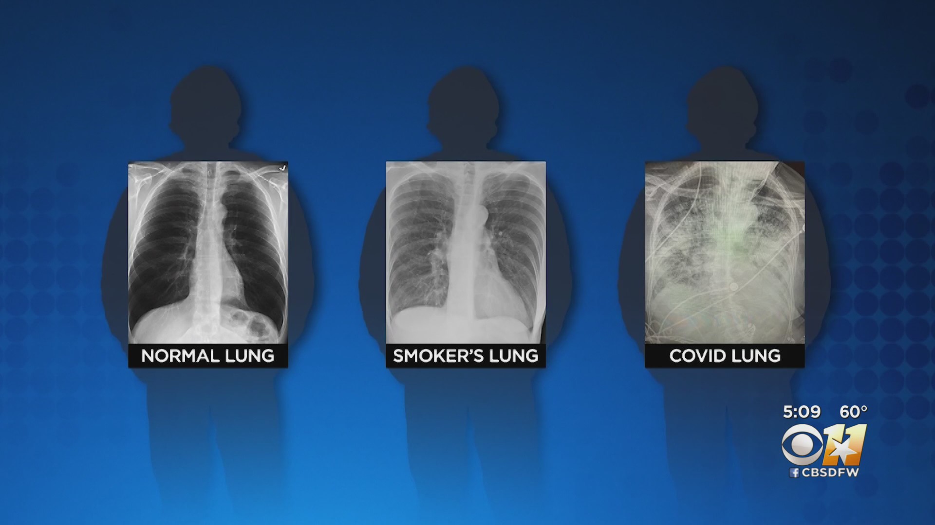 normal chest x ray - Normal Lung Smoker'S Lung Covid Lung 60 Ok Cbsdfw