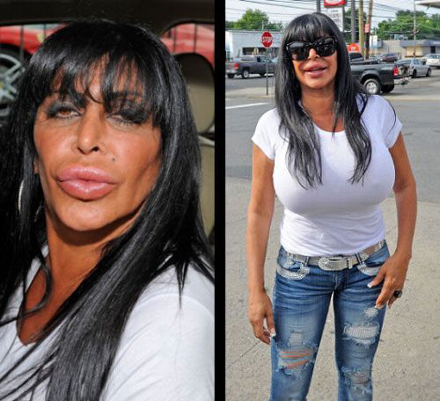 21 Extremely Botched Plastic Surgeries Gallery Ebaums World 