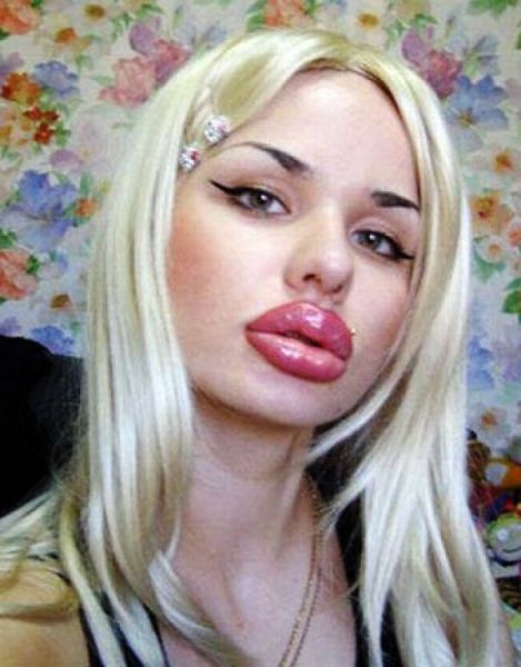 21 Extremely Botched Plastic Surgeries