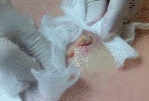 gifs - pimple popping
