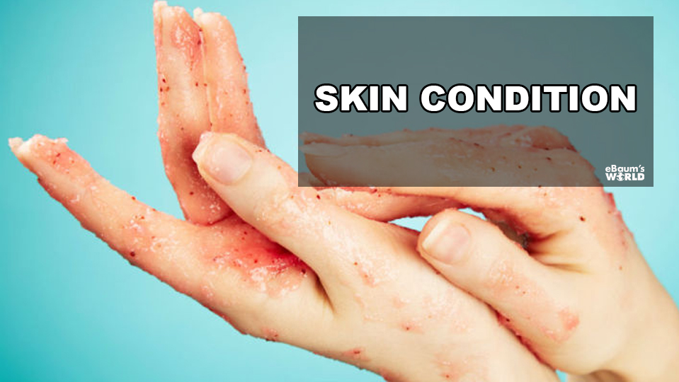 Skin Condition