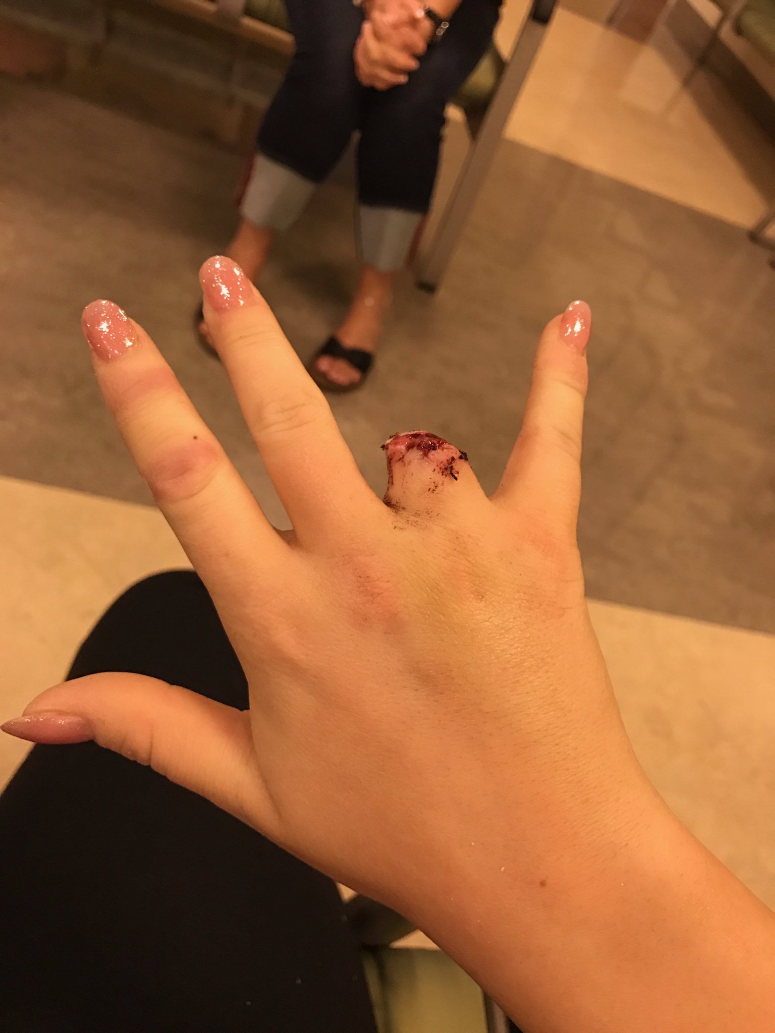 PSA: Don't jump a fence with a ring on.