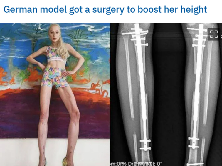 cursed pics and photos - theresia fisher - German model got a surgery to boost her height m0f% Drehwinkel 0 H
