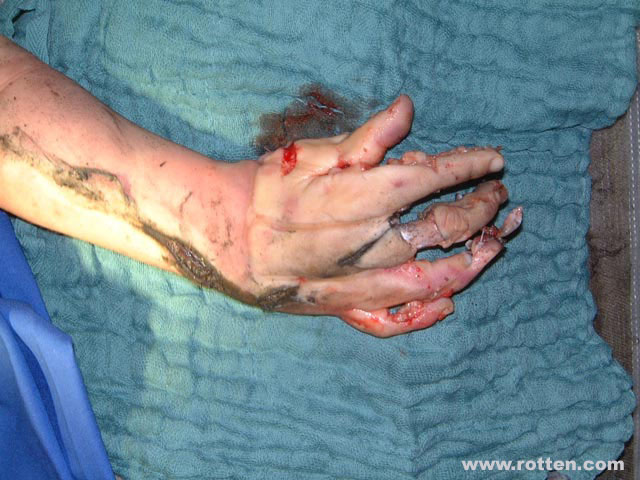 Boy's hand caught in a meat grinder