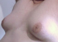 Man Tits, Moobs or Gynecomastia