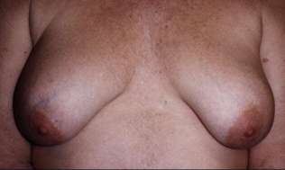 Man Tits, Moobs or Gynecomastia