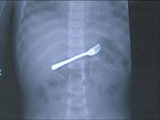 this person swallowed a fork
