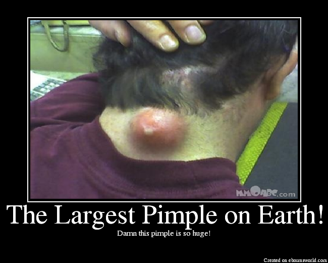 Damn this pimple is so huge!