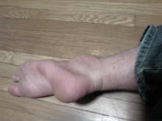 About six months ago I would roll my ankle all the time, here is what it looked like!