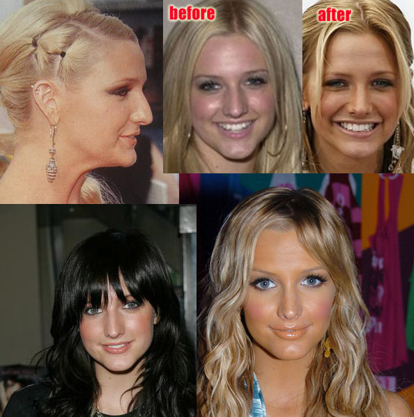 Celeb Before And After Plastic Surgery