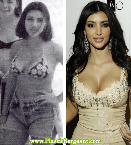 Celeb Before And After Plastic Surgery