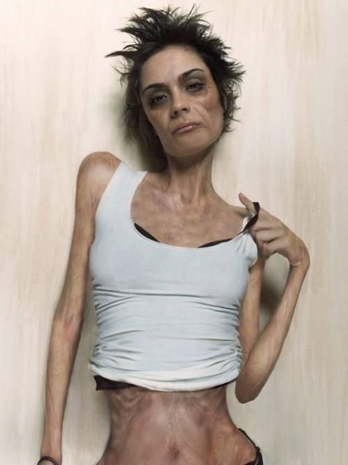 Anorexic Celebs