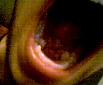 these are my adult teeth grown in irregularly because i never lost my baby teeth and never will.