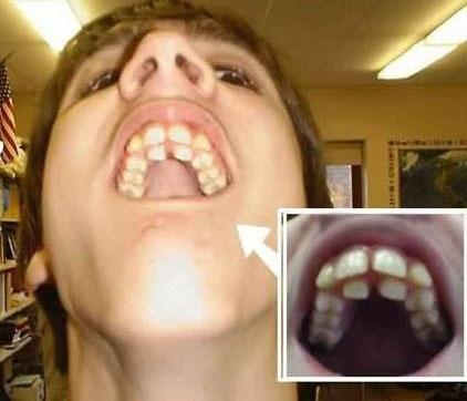 This Kid Has An Extra Row Of Teeth