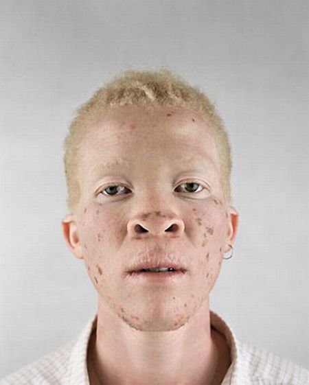 Albino Black People