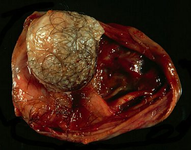 Teratoma tumor.  This type of cancer can become any cell in the body and is possible for it to have teeth or even hair like this one.