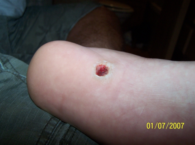 This what happens when you have a plantar wart removed! Healing time 6 to 8 weeks!!