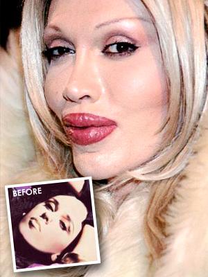Celebrities and plastic surgery