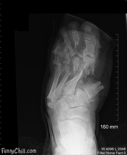 Painful X-rays