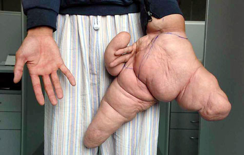 This man was born with the biggest left thumb, index and middle finger in the world