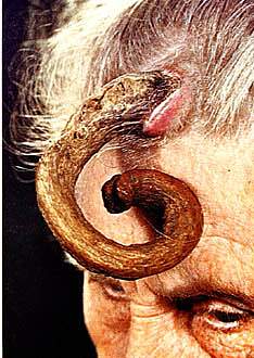Woman with Actinic Keratosis, a skin cancer