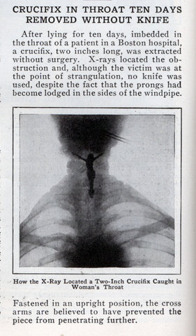 A vintage news clip showing a crucix lodged in a throat for 10 days and then removed without a knife. How? Why?