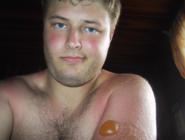 A sunburn I got wile in Costa Rica.