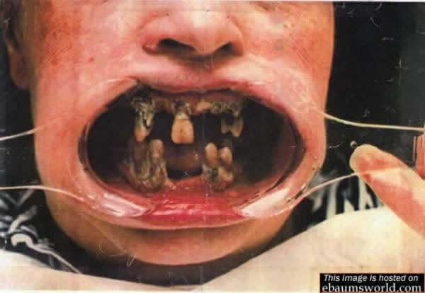 omfg this kid has no dental care!