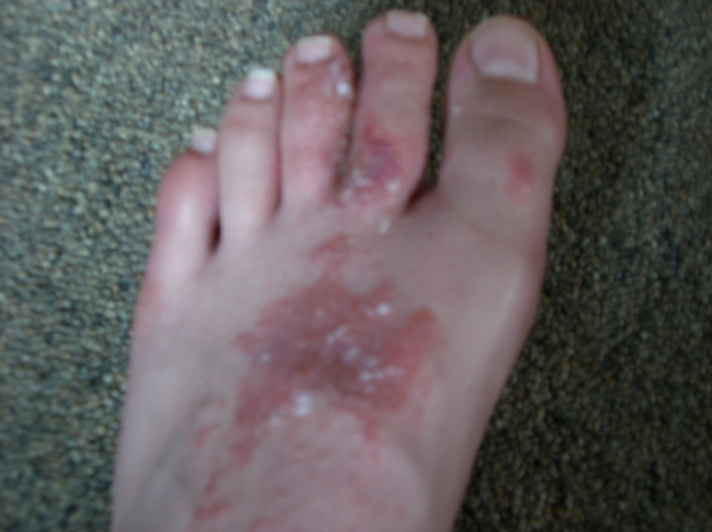 i got nasty poison ivy  cause iwnet bare foot through the woods