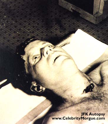 morgue autopsy jfk