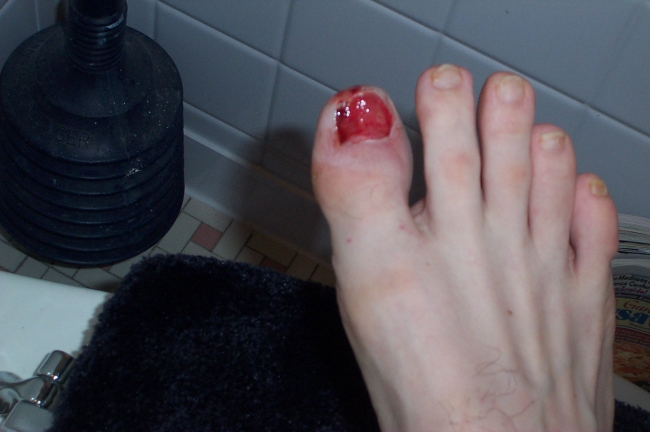Stubbed my toe playing volleyball, GROSS