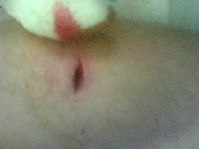 after they cut open my leg to get it out!