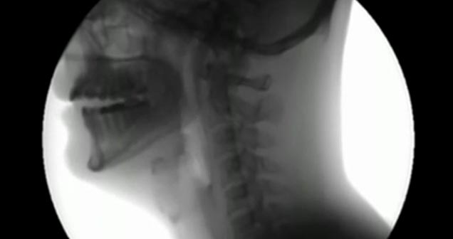 X-Ray of Human Swallowing