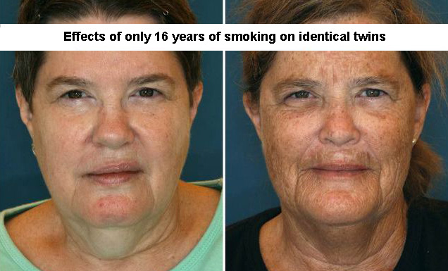 collection of interesting and cool pictures | a photo of identical twins and the effects of smoking