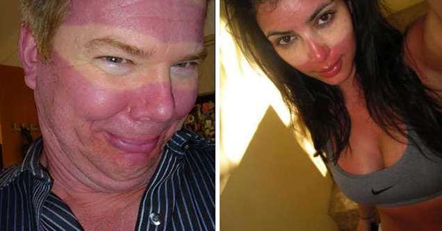 18 People Whose Vacation Got Ruined by Sunburn