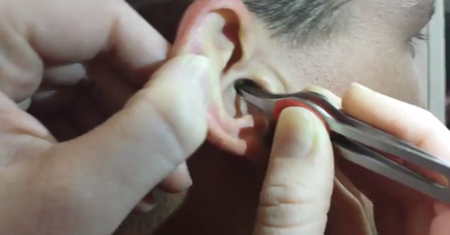 Woman Pulls HUGE Lump of Earwax From Man’s Ear