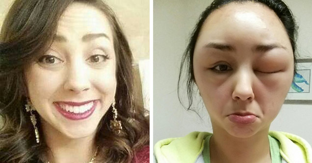 Girl Has A Bad Reaction To Hair Dye That Will Shock You