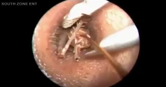 Gross! Huge Bug Removed From Dude's Ear