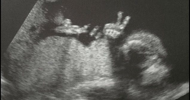 ultrasound of baby giving the victory sign