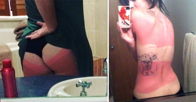 bad sun burns on back and butt